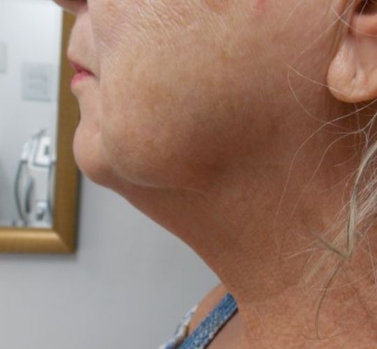 Skin Laxity Kansas City