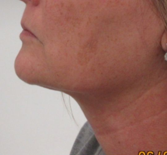 Skin Laxity Kansas City