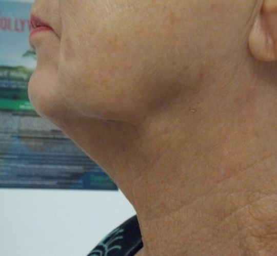 Skin Tightening Kansas City