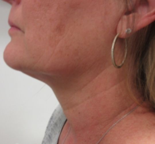 Skin Laxity Kansas City