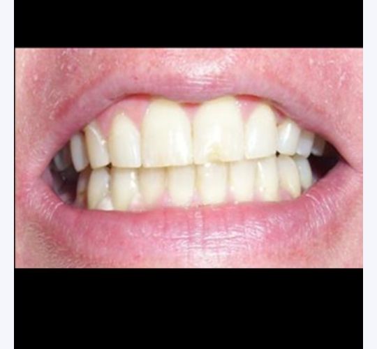 Teeth Whitening Kansas City