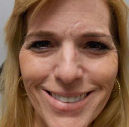 Juvederm Kansas City