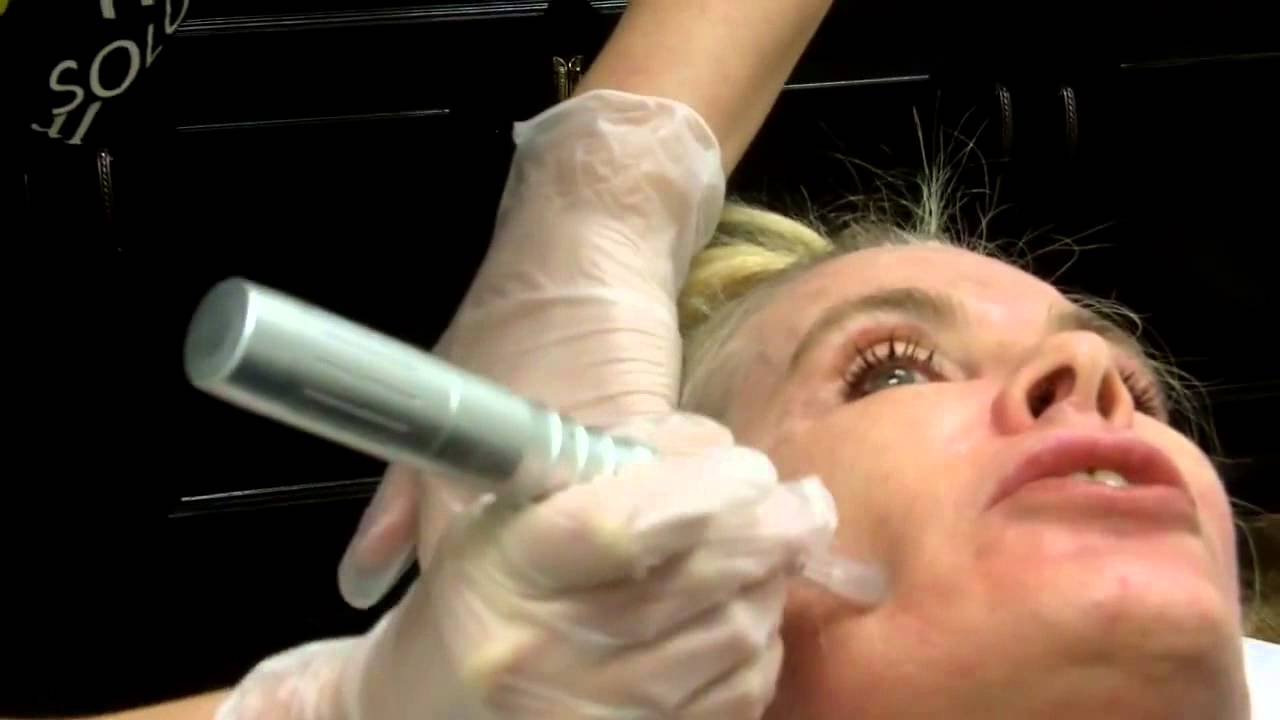 microneedling