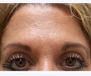 Botox Kansas City