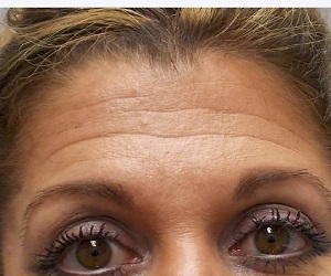 Botox Kansas City
