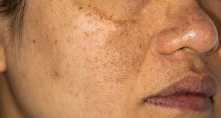 Hyperpigmentation Kansas City