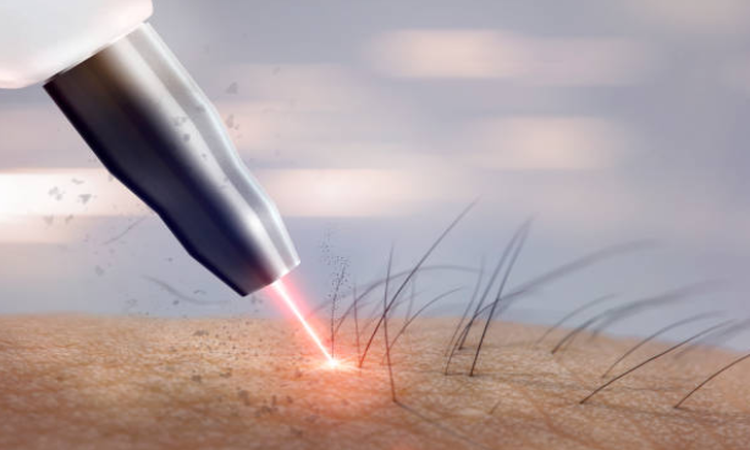Kansas City Laser Hair Removal