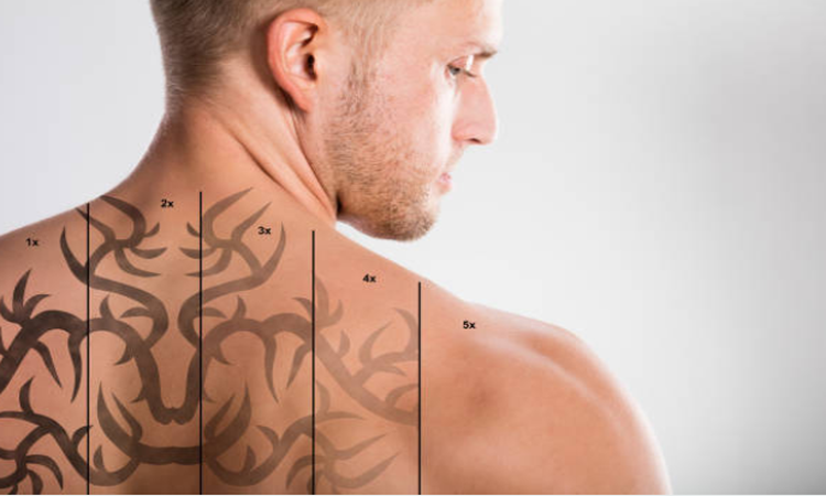 Laser Tattoo Removal Kansas City