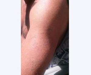 Laser tattoo removal Kansas City