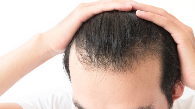 Hair loss treatment Lee’s Summit