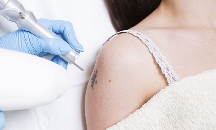 Laser Tattoo Removal Kansas City